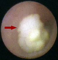 Endoscopic view of salivary gland stone.