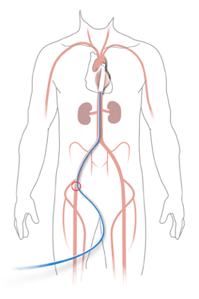 Endovascular route of delivery catheter (blue) for placement of stent, going from within femoral artery in upper groin, via small incision (circled in red), to thoracic aorta of heart.