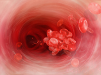 Red blood cells clumped together form a blood clot (thrombus) that can block blood flow in the body's deep veins, and cause potentially life-threatening DVT.