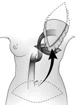 TRAM flap reconstruction with pedicled/tunneled rectus abdominus muscle and abdominal skin-island for creation of breast.