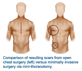 Comparison of resulting scars from open chest surgery (left) versus minimally invasive surgery via mini-thoracotomy.